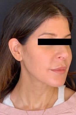 After morpheus 8, right front oblique view — a patient of Dr. George Ferzli, New York