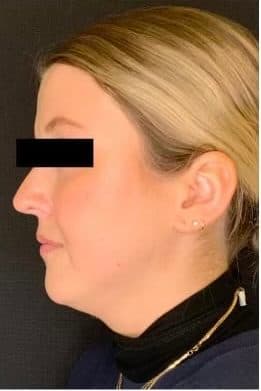 Before restylane chin, left side view — a patient of Dr. George Ferzli, New York