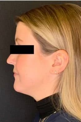 After restylane chin, left side view — a patient of Dr. George Ferzli, New York