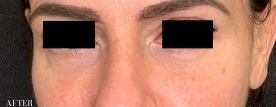 After restylane undereye filler, front view — a patient of Dr. George Ferzli, New York