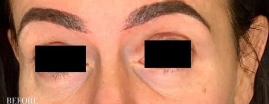Before restylane undereye filler, front view — a patient of Dr. George Ferzli, New York