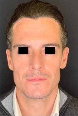 After xeomin, front view — a patient of Dr. George Ferzli, New York