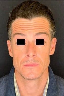 Before xeomin, front view — a patient of Dr. George Ferzli, New York