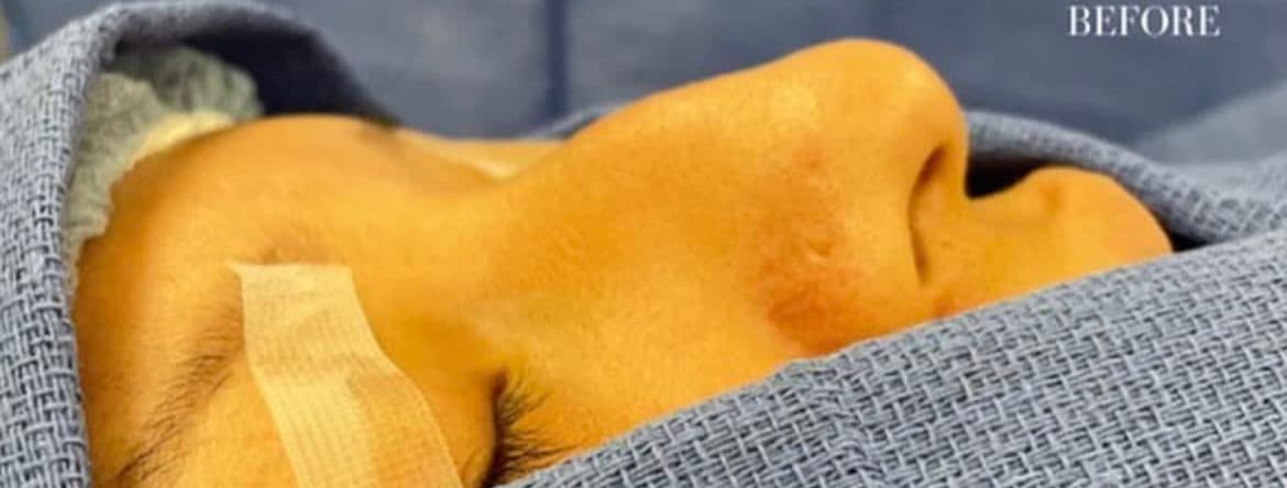 Before surgical rhinoplasty, front view — a patient of Dr. George Ferzli, New York
