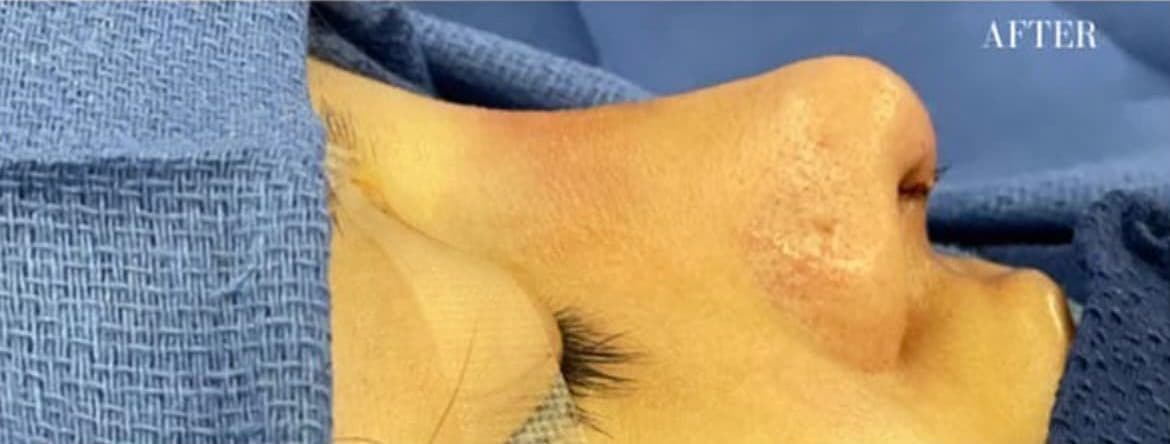 After surgical rhinoplasty, front view — a patient of Dr. George Ferzli, New York