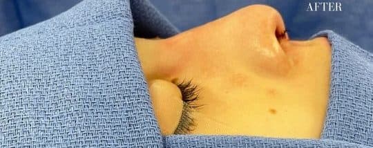 After surgical rhinoplasty, front view — a patient of Dr. George Ferzli, New York