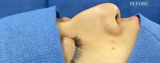 Before surgical rhinoplasty, front view — a patient of Dr. George Ferzli, New York
