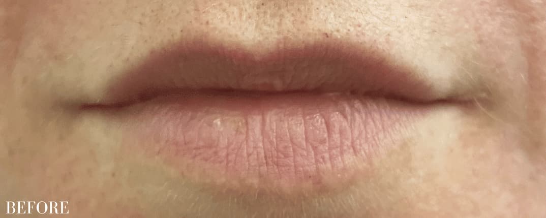 Before restylane kysse, front view — a patient of Dr. George Ferzli, New York