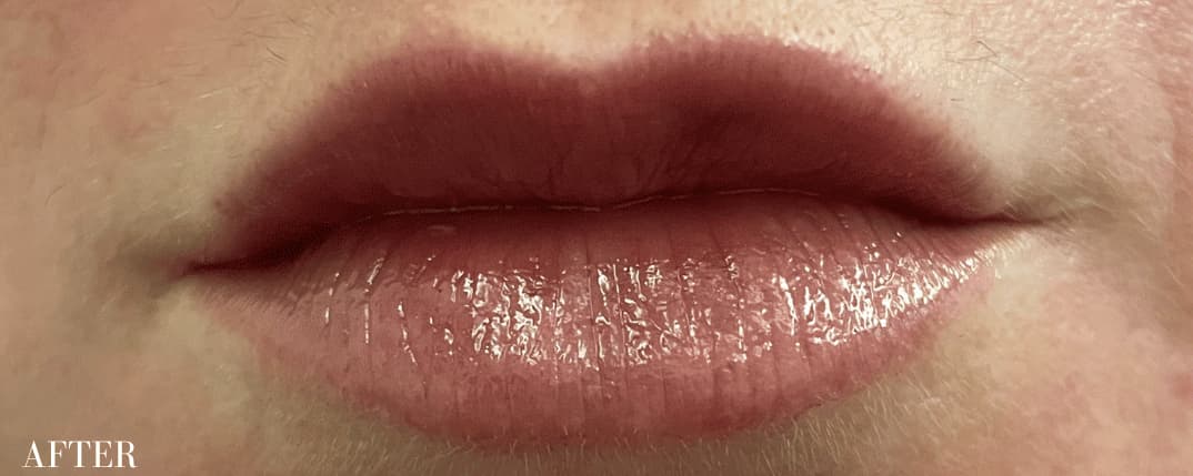 After restylane kysse, front view — a patient of Dr. George Ferzli, New York