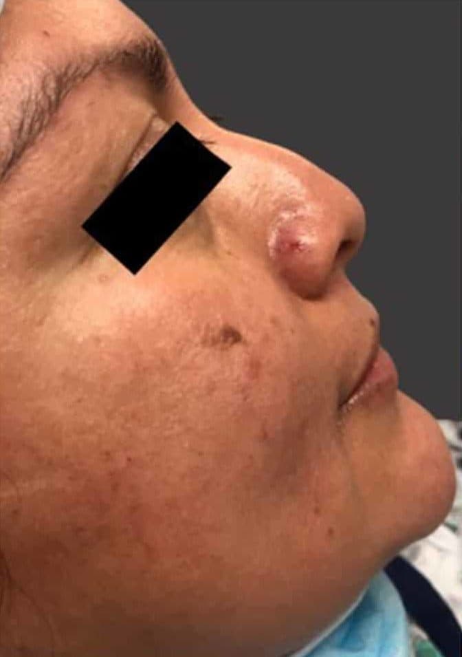 Before surgical rhinoplasty, right side view — a patient of Dr. George Ferzli, New York