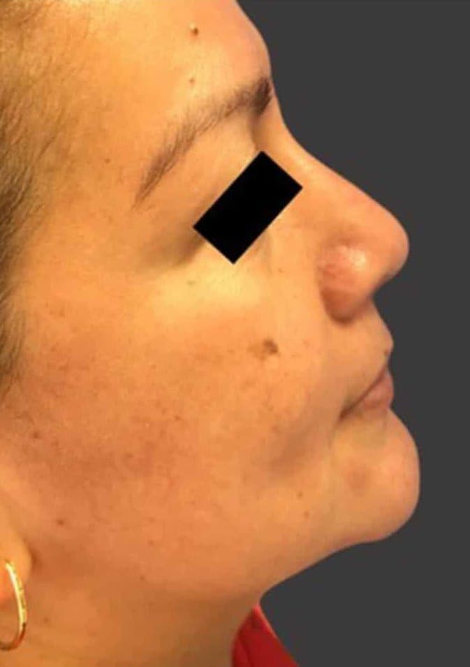 After surgical rhinoplasty, right side view — a patient of Dr. George Ferzli, New York