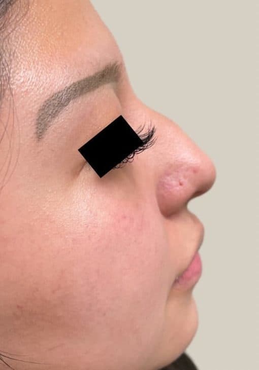 Before surgical rhinoplasty, right side view — a patient of Dr. George Ferzli, New York
