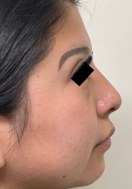 After surgical rhinoplasty, right side view — a patient of Dr. George Ferzli, New York