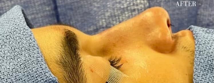 After surgical rhinoplasty, front view — a patient of Dr. George Ferzli, New York