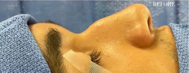 Before surgical rhinoplasty, front view — a patient of Dr. George Ferzli, New York