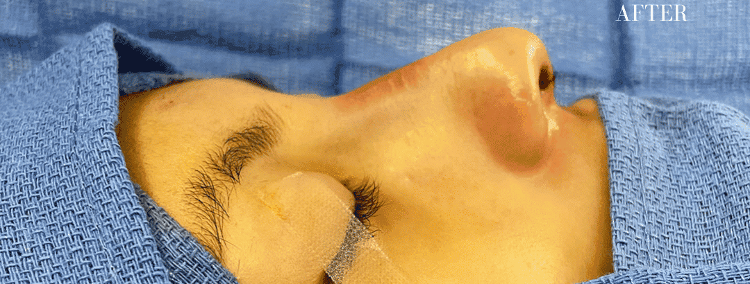 After surgical rhinoplasty, front view — a patient of Dr. George Ferzli, New York