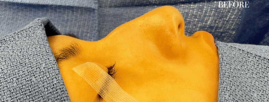 Before surgical rhinoplasty, front view — a patient of Dr. George Ferzli, New York