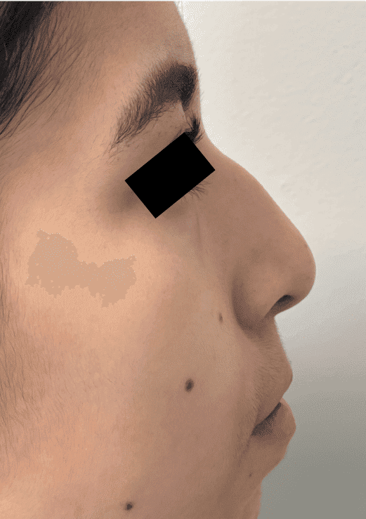 Before surgical rhinoplasty, right side view — a patient of Dr. George Ferzli, New York