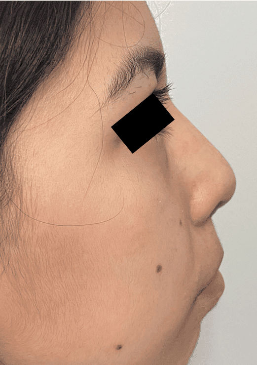 After surgical rhinoplasty, right side view — a patient of Dr. George Ferzli, New York