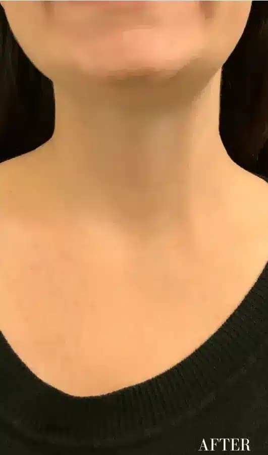 After xeomin, front view — a patient of Dr. George Ferzli, New York
