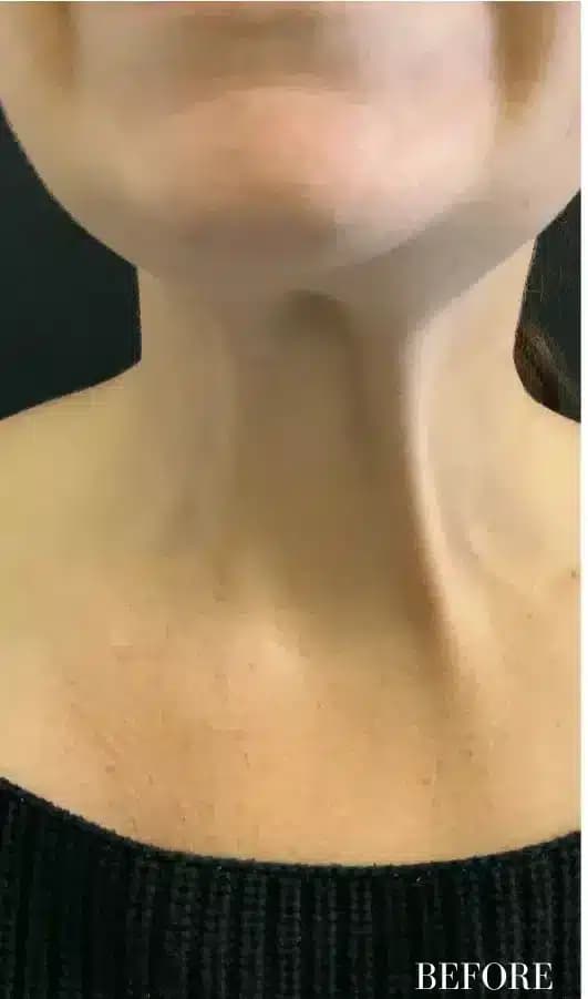 Before xeomin, front view — a patient of Dr. George Ferzli, New York