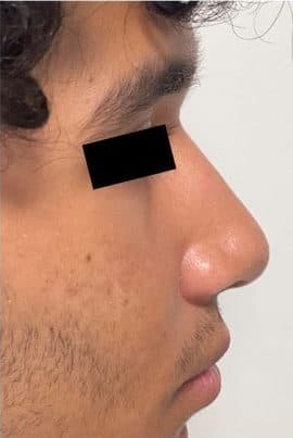 After surgical rhinoplasty, right side view — a patient of Dr. George Ferzli, New York