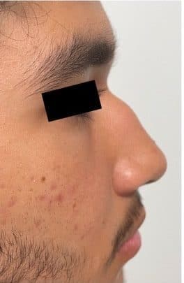 Before surgical rhinoplasty, right side view — a patient of Dr. George Ferzli, New York