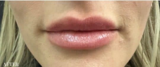 After restylane kysse, front view — a patient of Dr. George Ferzli, New York