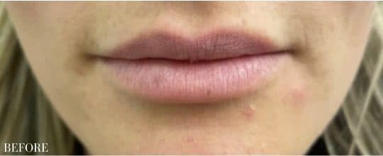 Before restylane kysse, front view — a patient of Dr. George Ferzli, New York