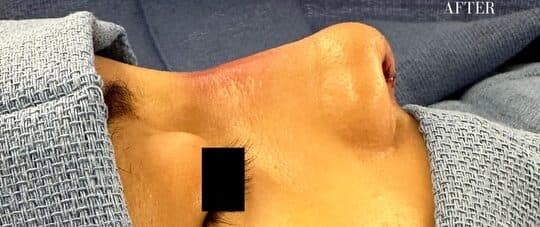 After rhinoplasty, right side view — a patient of Dr. George Ferzli, New York
