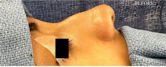Before rhinoplasty, right side view — a patient of Dr. George Ferzli, New York