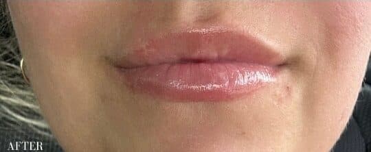 After restylane kysse, front view — a patient of Dr. George Ferzli, New York