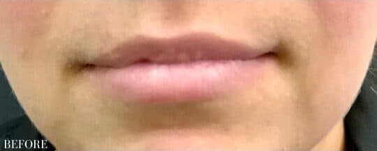 Before restylane kysse, front view — a patient of Dr. George Ferzli, New York