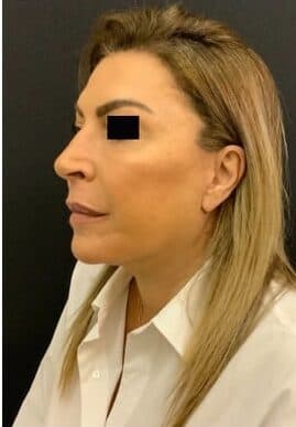 After face and neck lift, left front oblique view — a patient of Dr. George Ferzli, New York