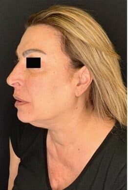 Before face and neck lift, left front oblique view — a patient of Dr. George Ferzli, New York