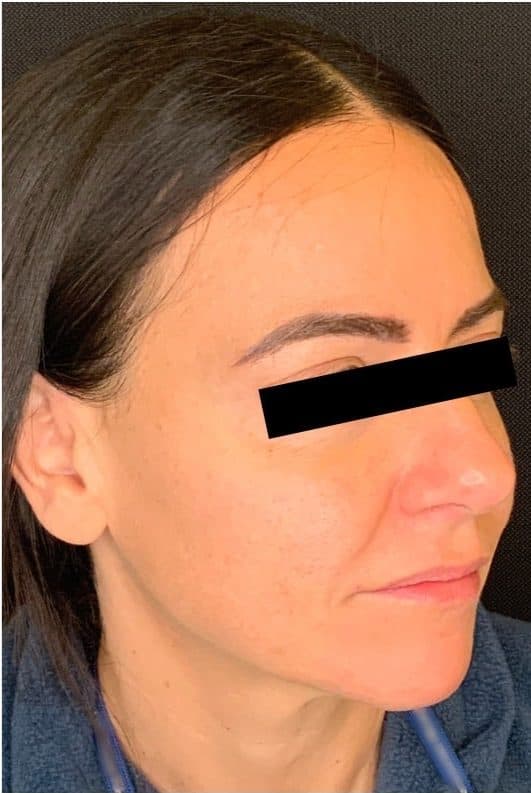 After morpheus 8, right side view — a patient of Dr. George Ferzli, New York