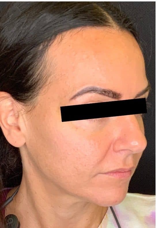 Before morpheus 8, right side view — a patient of Dr. George Ferzli, New York