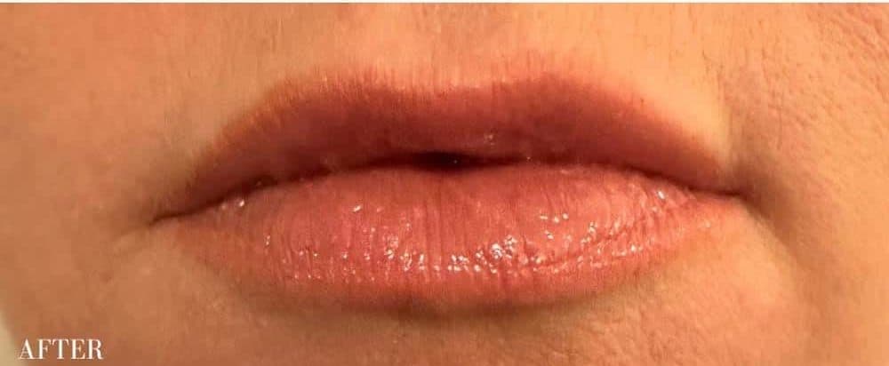 After restylane kysse, front view — a patient of Dr. George Ferzli, New York