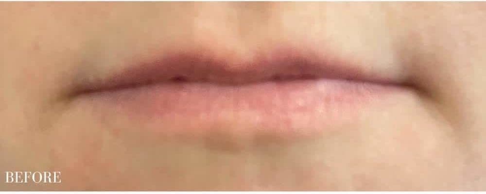 Before restylane kysse, front view — a patient of Dr. George Ferzli, New York
