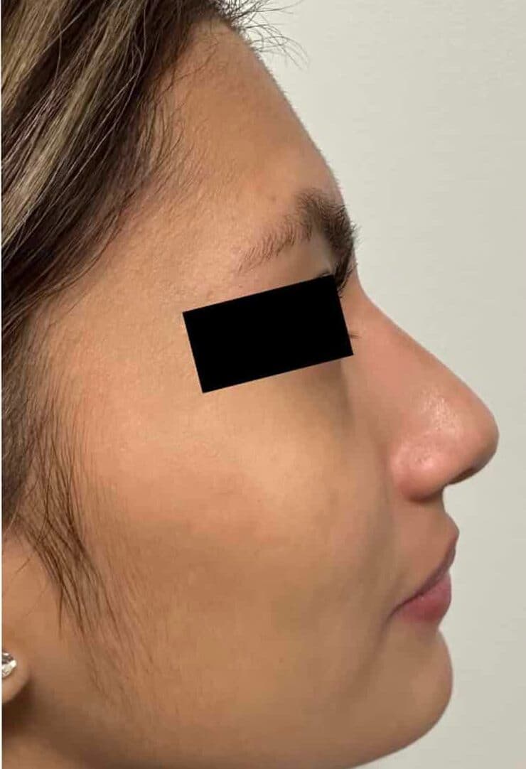 After surgical rhinoplasty, right side view — a patient of Dr. George Ferzli, New York