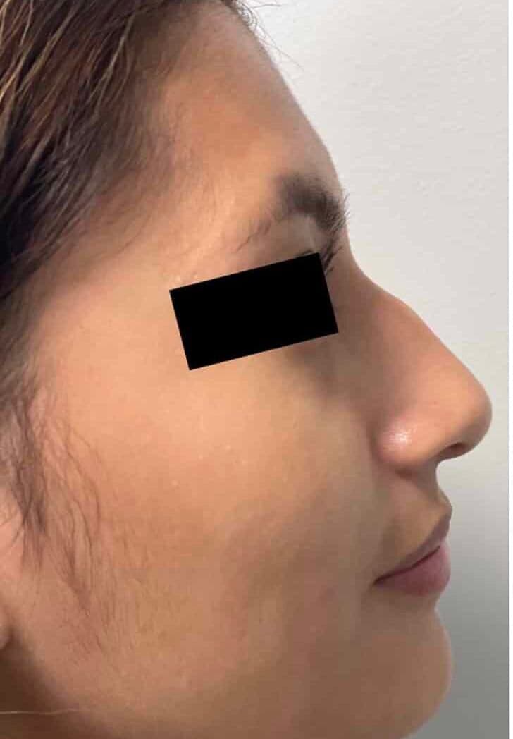 Before surgical rhinoplasty, right side view — a patient of Dr. George Ferzli, New York