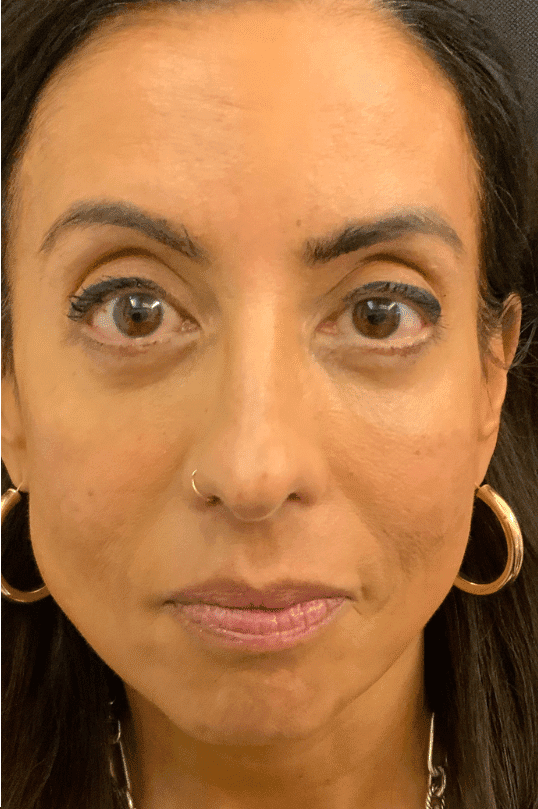After blepharoplasty, front view — a patient of Dr. George Ferzli, New York