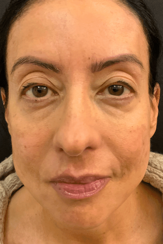 Before blepharoplasty, front view — a patient of Dr. George Ferzli, New York
