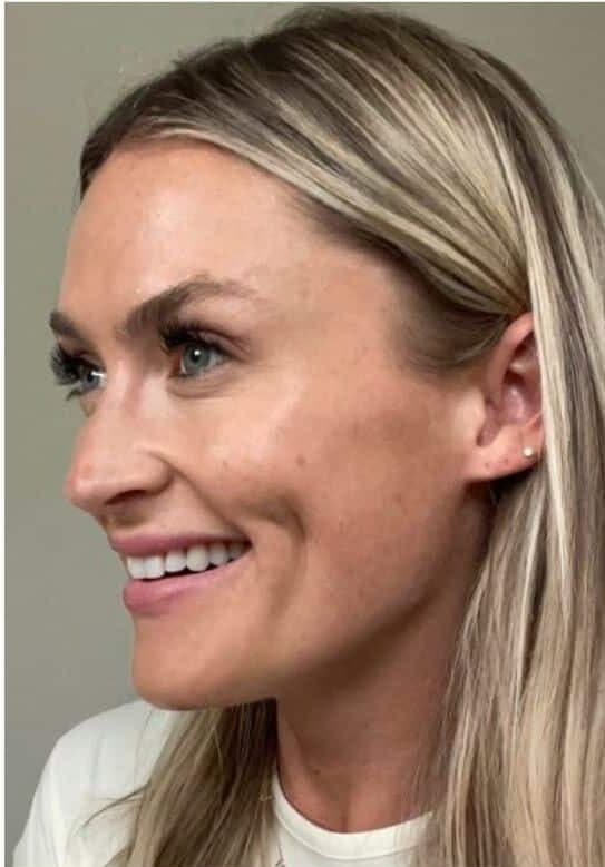 After xeomin, left front oblique view — a patient of Dr. George Ferzli, New York