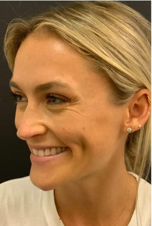 Before xeomin, left front oblique view — a patient of Dr. George Ferzli, New York