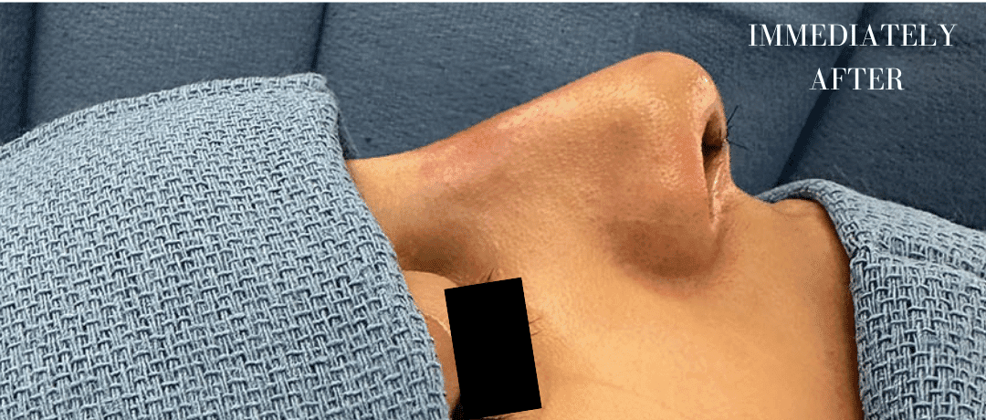 After rhinoplasty, right side view — a patient of Dr. George Ferzli, New York