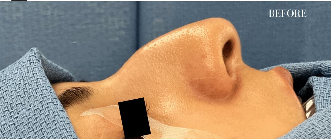 Before rhinoplasty, right side view — a patient of Dr. George Ferzli, New York