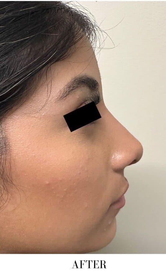After rhinoplasty, right side view — a patient of Dr. George Ferzli, New York