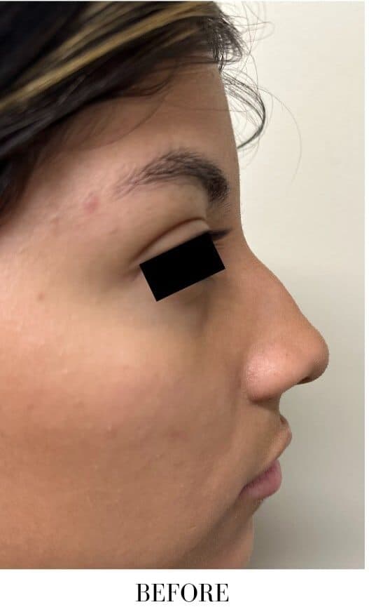 Before rhinoplasty, right side view — a patient of Dr. George Ferzli, New York