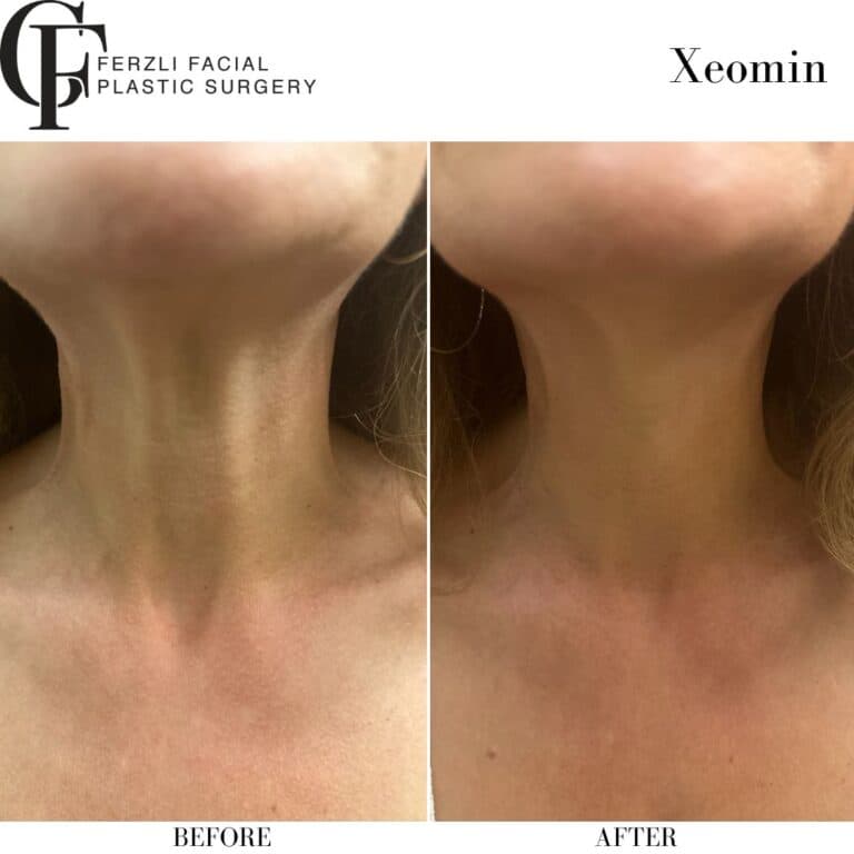 Before and after xeomin, front view — a patient of Dr. George Ferzli, New York